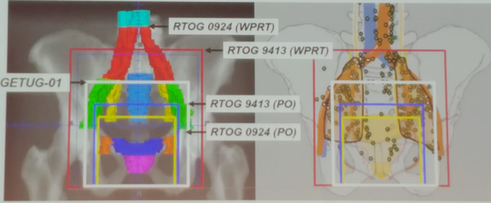 Various PLND Templates in Prostate Cancer