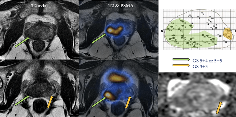 APCCC_future_of_PCa_imaging.png