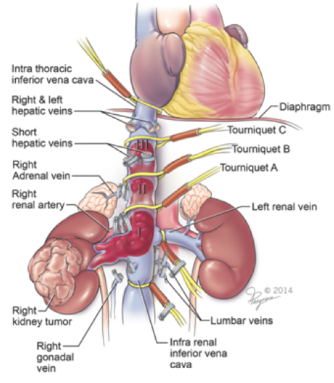 SIU19_tumor_thrombus.png