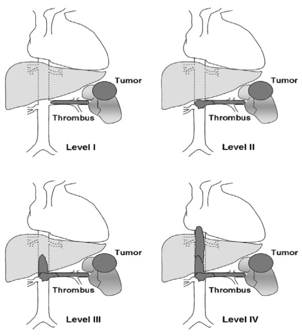 SIU19_thrombus.png